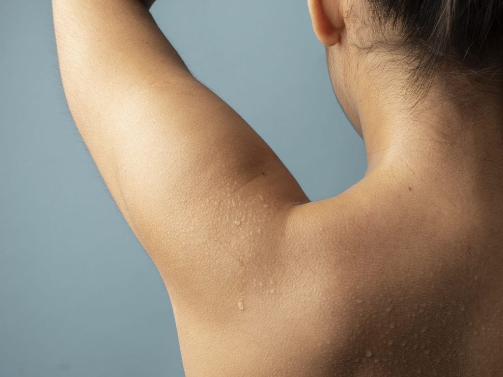 HIPRHIDROSIS