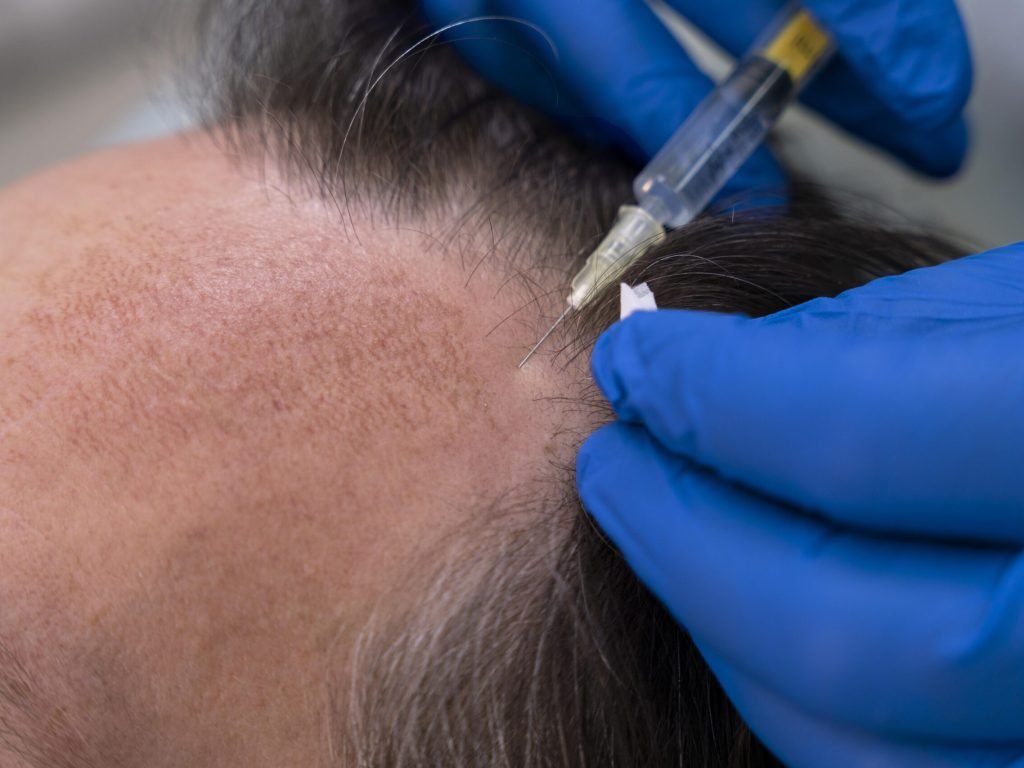 MESOTERAPIA CCAPILAR